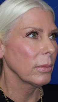 FACEology Lift / Neck Lift