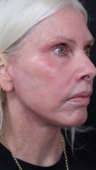 FACEology Lift / Neck Lift