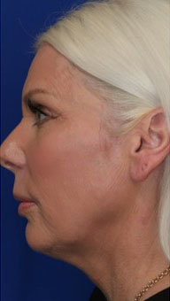 FACEology Lift / Neck Lift