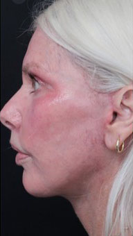 FACEology Lift / Neck Lift