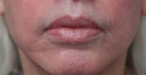 FACEology Lift / Neck Lift