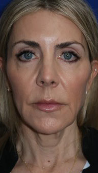 FACEology Lift / Neck Lift