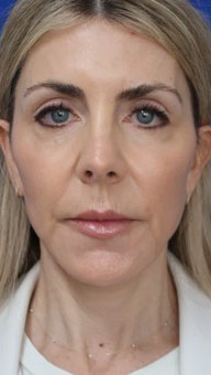 FACEology Lift / Neck Lift