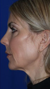 FACEology Lift / Neck Lift