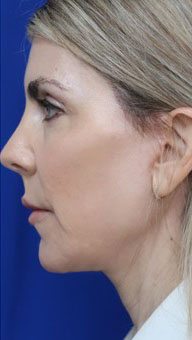 FACEology Lift / Neck Lift