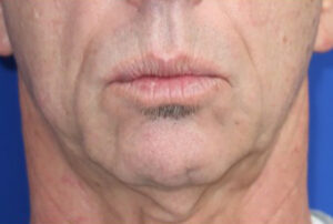 FACEology Lift / Neck Lift