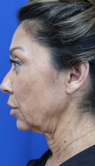 FACEology Lift / Neck Lift