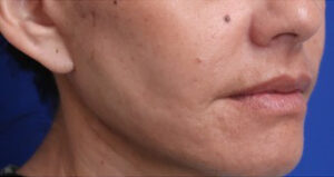 FACEology Lift / Neck Lift