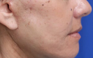 FACEology Lift / Neck Lift