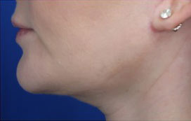 FACEology Lift / Neck Lift