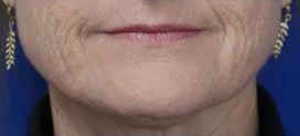 FACEology Lift / Neck Lift