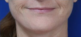 FACEology Lift / Neck Lift