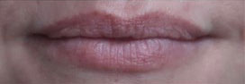 Lip Augmentation