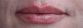 Lip Augmentation