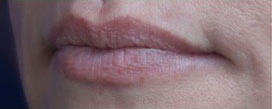 Lip Augmentation