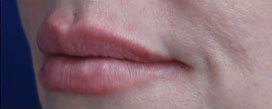 Lip Augmentation