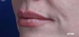 Lip Augmentation Before and After Photos