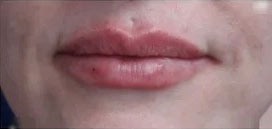 Lip Augmentation Before and After Photos