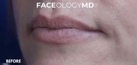 Lip Augmentation Before and After Photos