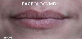 Lip Augmentation Before and After Photos