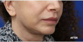 Lip Augmentation Before and After Photos