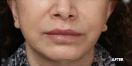 Lip Augmentation Before and After Photos