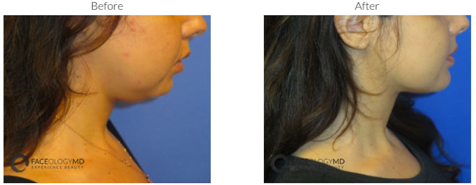 Cheek Augmentation Newport Beach Chin Implants Orange County
